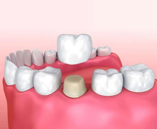 24-Hour Crowns service at Sure Smile Dental Clinic, Khar West