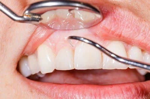 GumCare service at Sure Smile Dental Clinic, Khar West