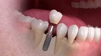 Dental Implants service at Sure Smile Dental Clinic, Khar West