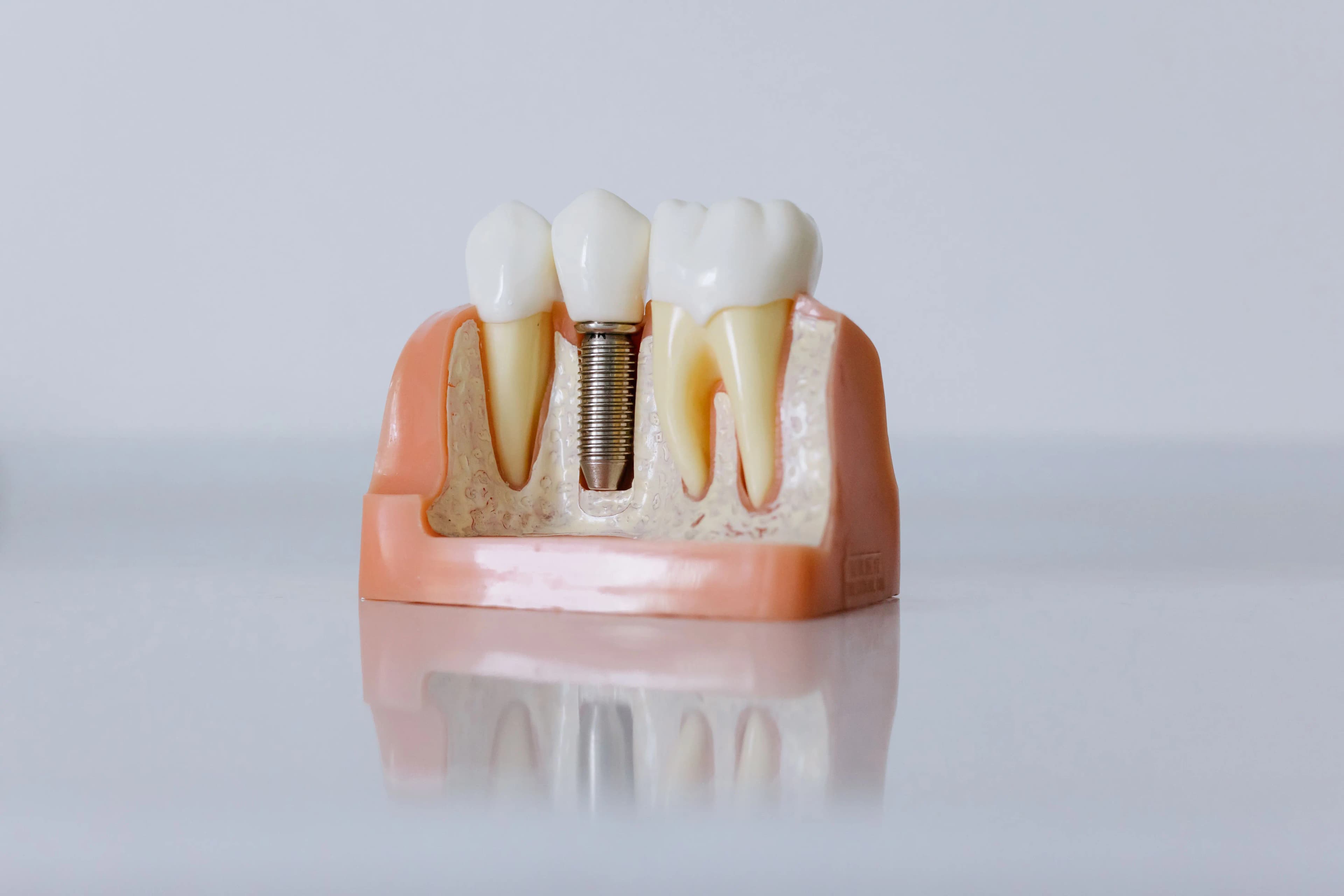 Root Canals service at Sure Smile Dental Clinic, Khar West